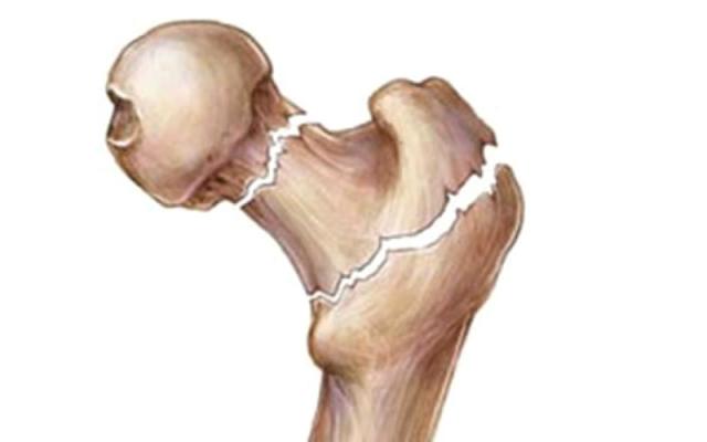 أعراض خطيرة تدل على إصابتك بسرطان العظام
